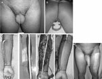 A 38-year-old man who underwent total penectomy and bilatera