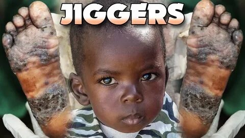 Little Emmanuel's Big Jiggers! Jiggers Removed! - YouTube