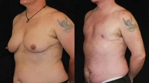FTM Top Surgery Gallery