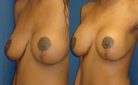 Before & After Breast lift with 600cc implants - Dr. Rodrigu