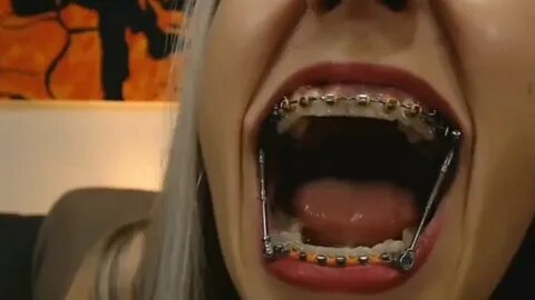 Braces herbst close up and talking - YouTube