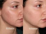microneedling-before-after-2 Dr Erickson Dermatology