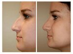 Rhinoplasty Nose Job Picture Gallery CHRISTOPHER T. JOHNSON,