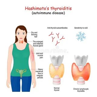 Autoimmune Thyroiditis, Hashimoto`s Disease Stock Illustrati