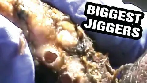 Andrew's Astounding Jigger Removal! Saving Fingers and FAQ -