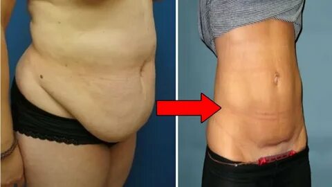 How to Lose Hanging Belly Fat After C Section Flat Stomach A