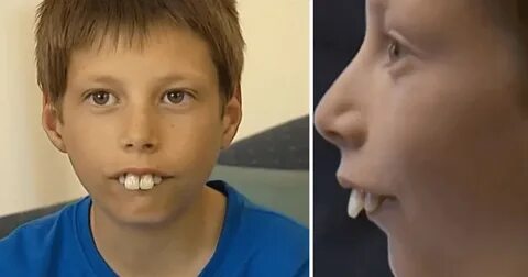 Boy Who Was Bullied For Overbite Gets Brand New Smile