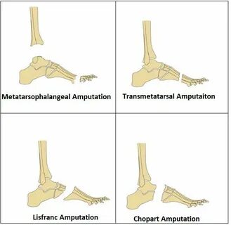 Amputation Of Lower Limb: Indication, Type, Physiotherapy tr