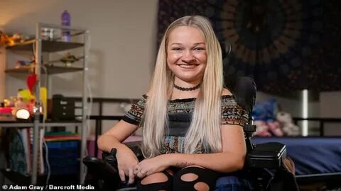 Alex Dacy dubbed 'Wheelchair Rapunzel' who was born with spi