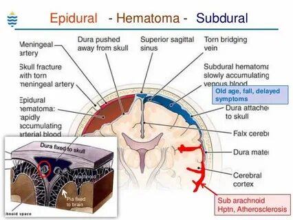 epidural vs subdural hematoma presentation - Google Search E