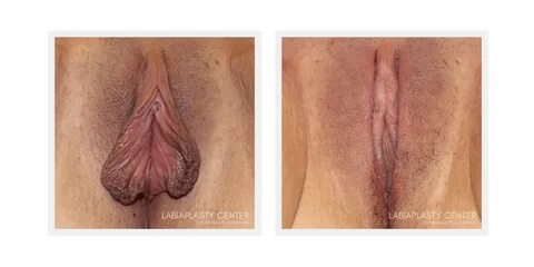 Gallery Page 2 Labiaplasty Center of Los Angeles