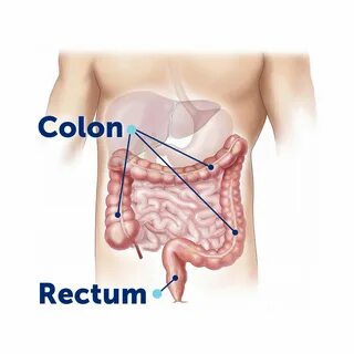 Soggiorno Aceto proiettore colon and rectum Timer pattuglia spagnolo