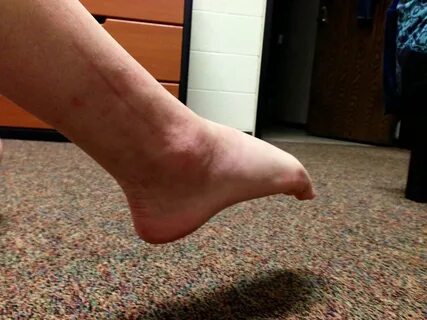 My Broken Ankle: 2013