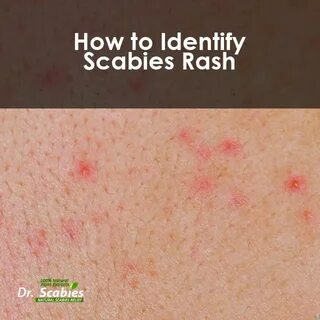 Dr. Scabies Blogs Best Scabies Treatment: Dr. Scabies - Home