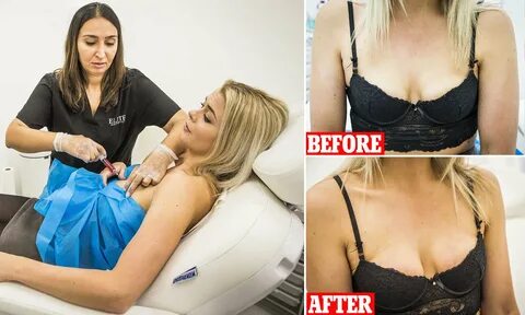 After boob lift women rest in what