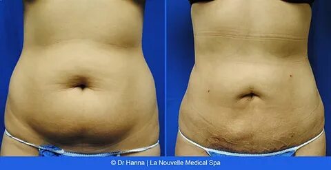 Laser Liposuction Before And After - change comin