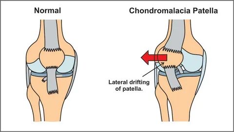 Chondromalacia patella : Causes , Symptoms , Diagnosis , Tre