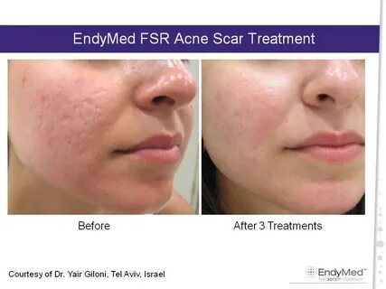 ENDYMED Medical в Твиттере: "Visible results on acne scars a