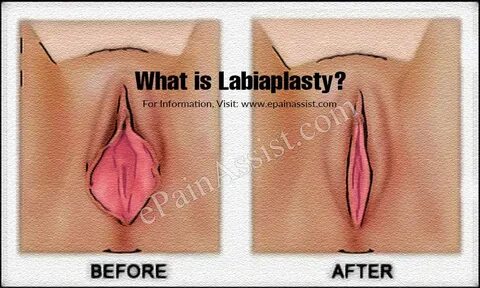 What is Labiaplasty Procedure Risks Complications Reasons Fo