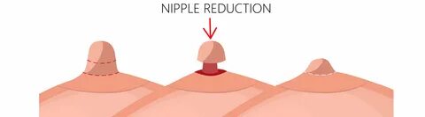 Boob lift and nipple reduction