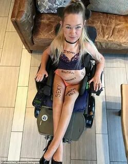 Wheelchair Rapunzel' with spinal disorder shares body positi