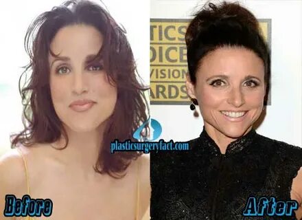 Julia Louis-Dreyfus Plastic Surgery Before and After - Plast
