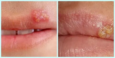 Герпес внутри губы - как лечить: симптомы, причины появления