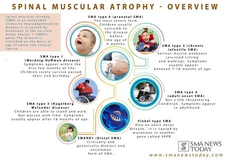 A Look At the Different Types of SMA Spinal muscular atrophy