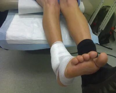 Broken ankle 33