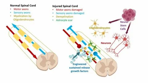 Spinal Cord Injury Program - Neural Stem Cell Institute, Ren