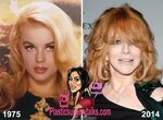 Ann Margret Plastic Surgery - Plastic Industry In The World