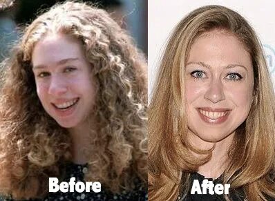 Chelsea Clinton Plastic Surgery Before and After Photo - Lat