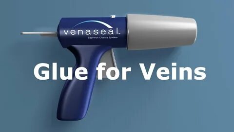 Instant Superglue for Varicose Veins - VenaSeal (TM) by Saph