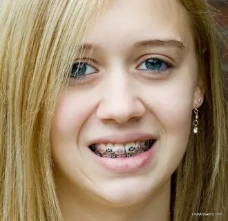 Orthodontics & Braces Oral Answers