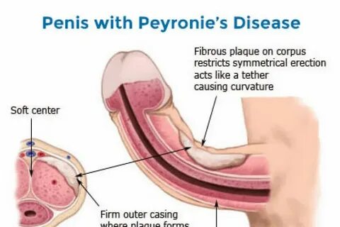 Kupinda Kwa Nyeti Ya Mwanamme (Peyronie’s Disease) - Doctor 