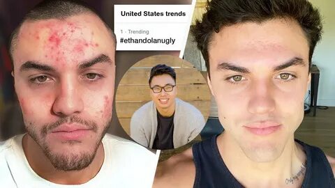 The Healthy Skin Coach Reacts To The Dolan Twins Acne Video 