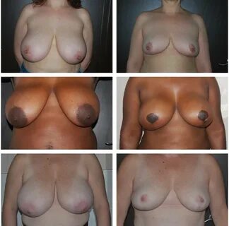 Breast Reduction Brooklyn Plastic Surgery.