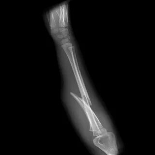 Monteggia fracture - wikidoc