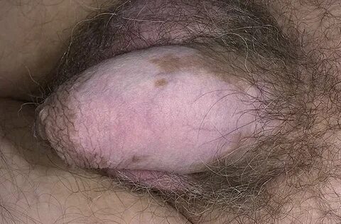 Vitiligo on the Penis Pictures - 7 Photos & Images / illness