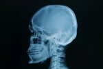 Skull x-rays image stock image. Image of anatomy, examine - 