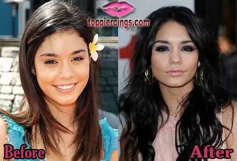 Vanessa Hudgens Nose Job Before and After Photos Top Piercin