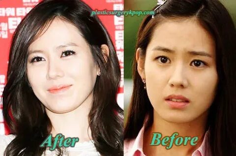 Son Ye Jin Plastic Surgery Before and After Pictures