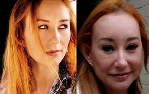 Tori Amos Plastic Surgery for unnatural looks!