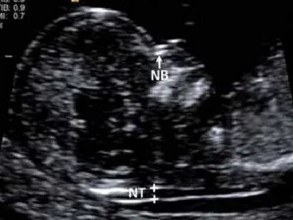 Normal nuchal translucency (NT, +) and normal nasal bone ass