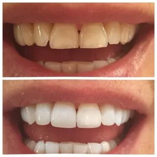 Before & After - Power Smile Dental Centre South Surrey BC