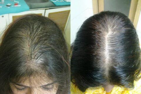 Лечение обильного выпадения волос