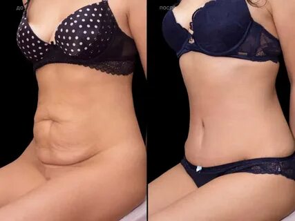 When is the Best Time for a Tummy Tuck?