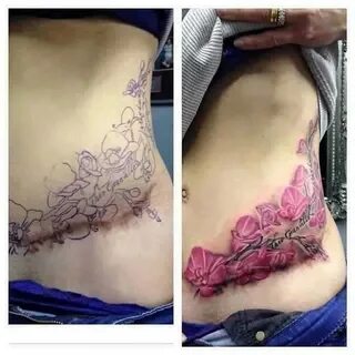 tummy tuck cover up tattoos 7 " Tummy Tuck: Prices, Photos, 