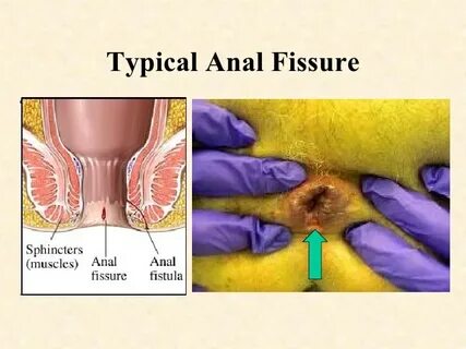 Immediate Relief For Anal Fissures Sex Pictures Pass