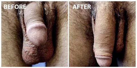 Penile Enlargement Treatment & Surgery Malaysia Safe Result